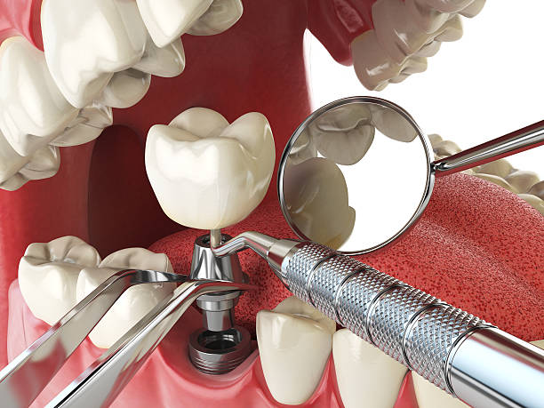 Best Emergency Wisdom Teeth Removal in Moses Lake North, WA